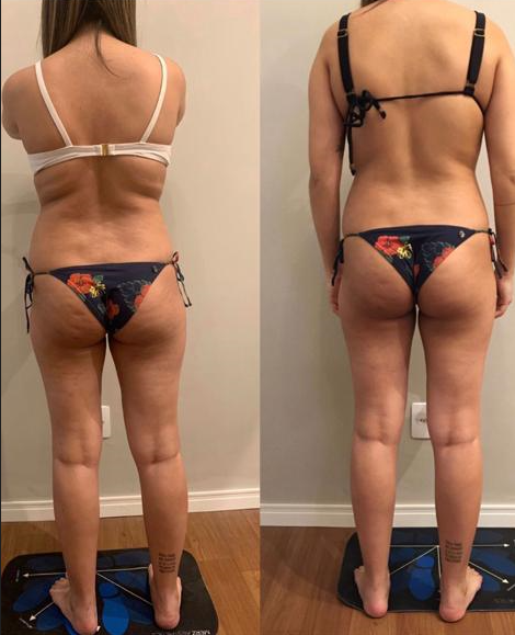 Emagrecimento brasilia celulite 01